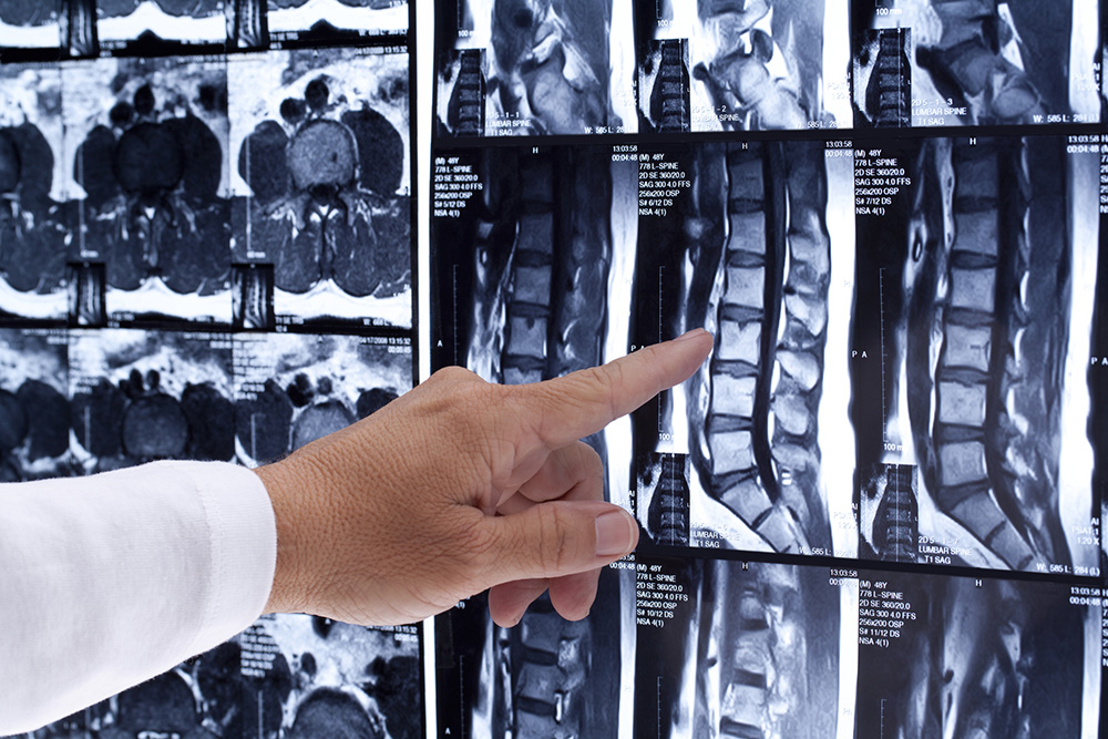 What You Need to Know About Spinal Cord Injuries Banner