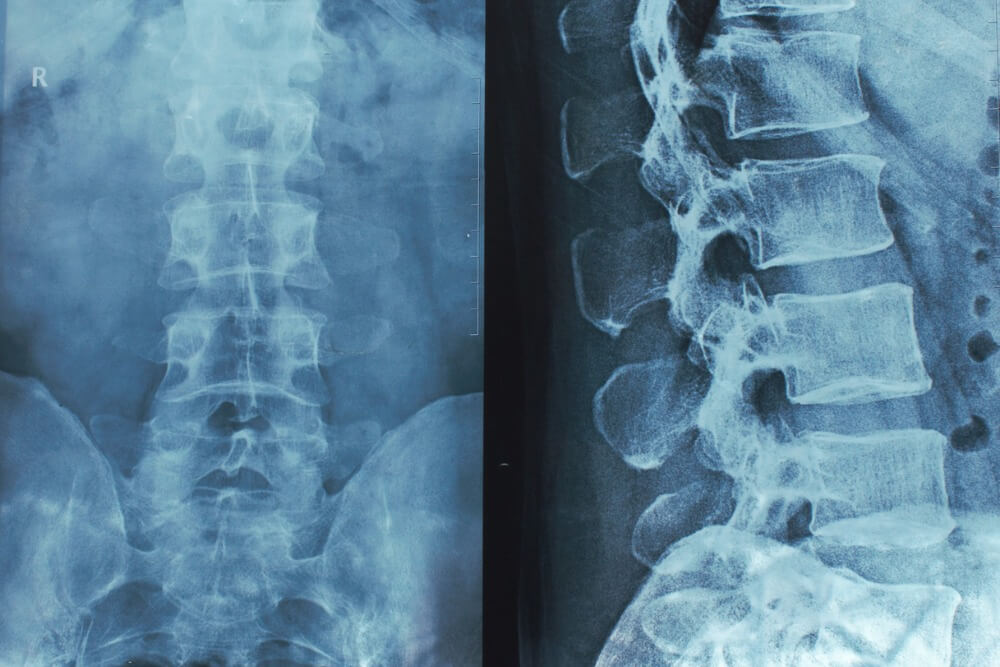 What Are My Legal Options After a Spinal Cord Injury? Banner